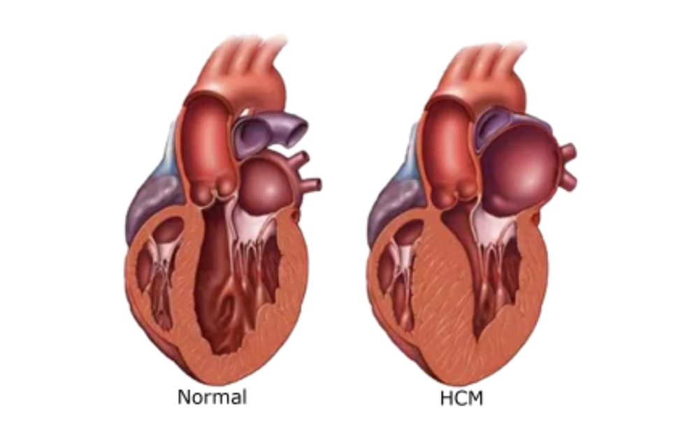 normal cat heart vs cat heart with hcm